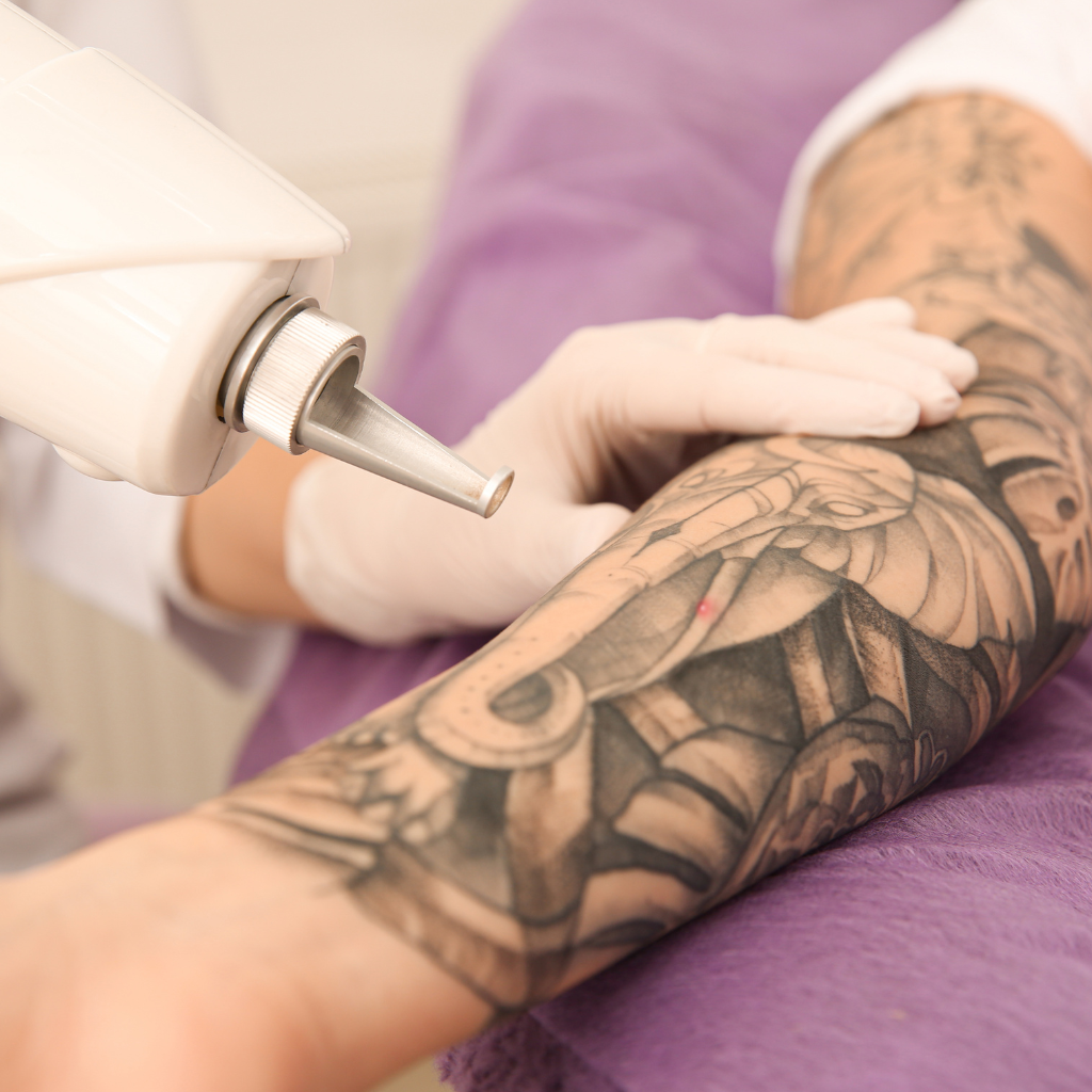 Tattoo removal treatment to reduce the appearance of unwanted tattoos.